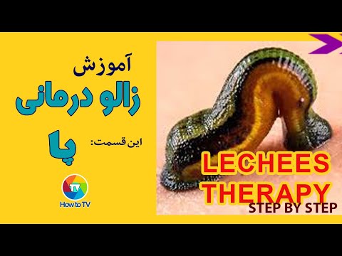 آموزش زالو درمانی روی پا حجامت عام Leeches Therapy YouTube