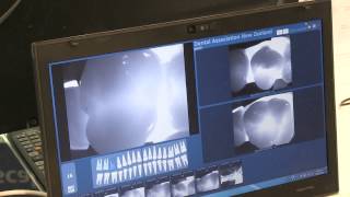 KaVo DIAGNOcam Demonstration