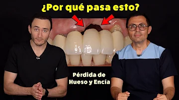 ¿Cuánta pérdida de hueso se produce tras una extracción dental?
