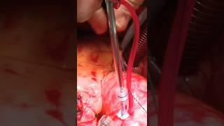 Witness the Heartbeat During Aneurysm Surgery #shorts #tiktok