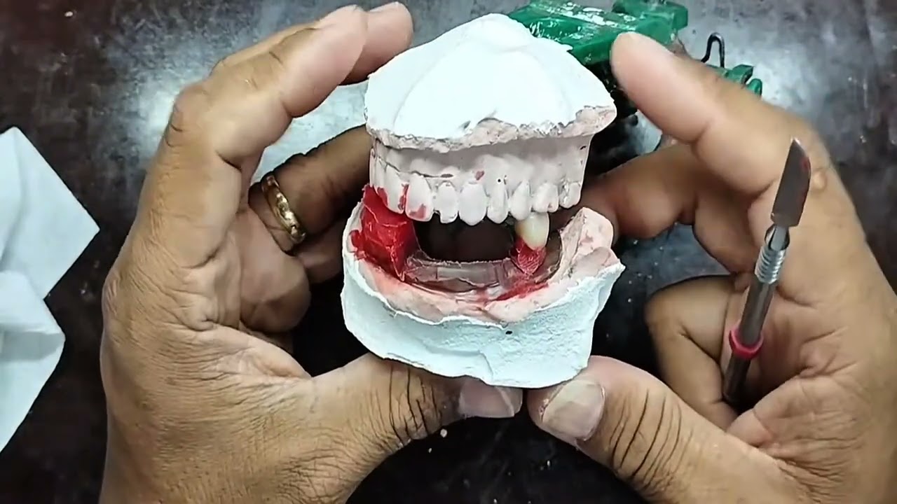 COMO SE INICIA A MONTAGEM DE UMA PRÓTESE TOTAL INFERIOR 