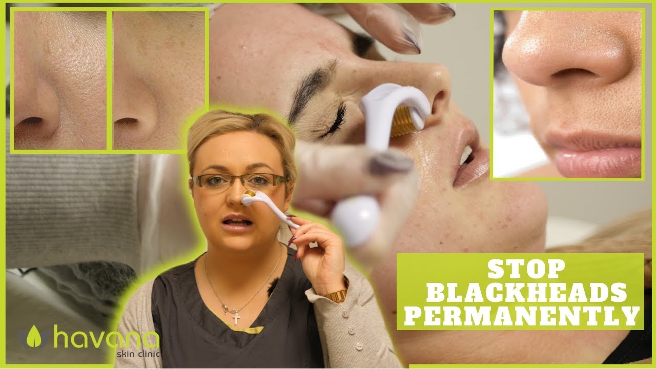 Derma Rolling Large Pores YouTube