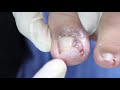 Ep_2451 Ingrown toenail removal 👣 ทะลุ หรือ ไม่  😷 (This clip is from Thailand)