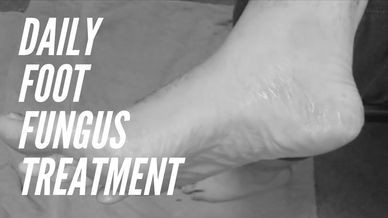 My Daily Foot Fungus Treatment YouTube