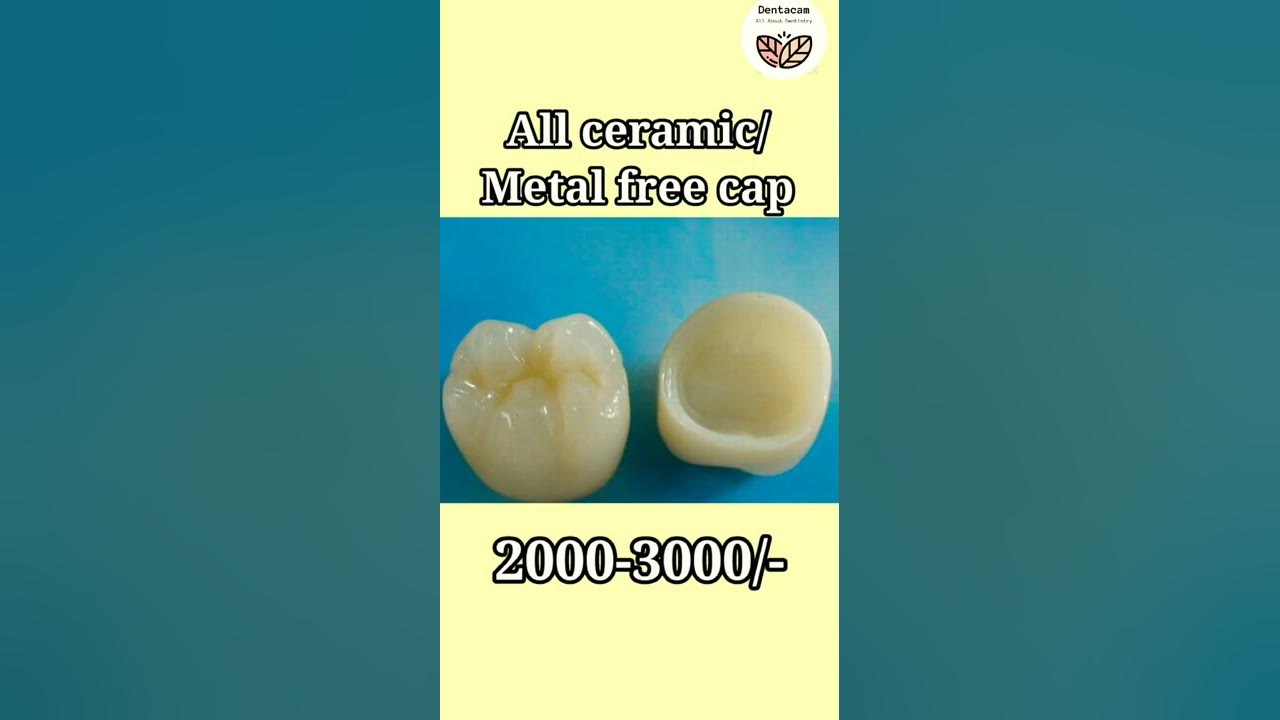 Types of dental caps/crown and cost