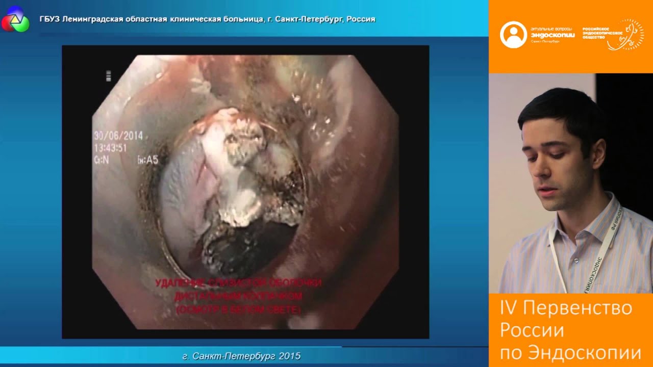 Использование нового способа эндоскопического лечения цилиндроклеточной метаплазии пищевода