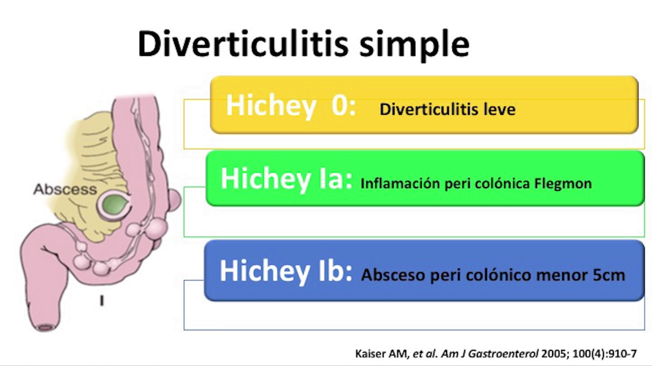 Diverticulitis Dra. Sandra Avendaño YouTube