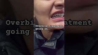 Overbite treatment brace in nepal