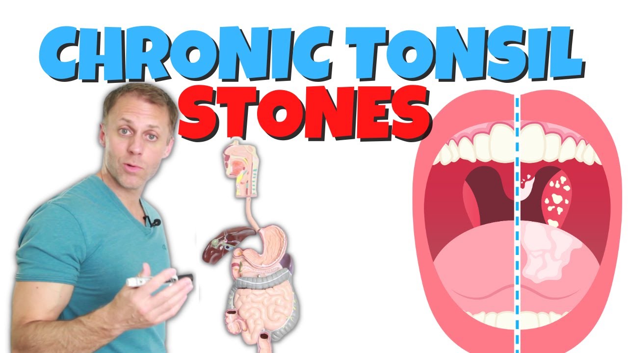 4 Steps For Chronic Tonsil Stones Tonsilloliths Youtube