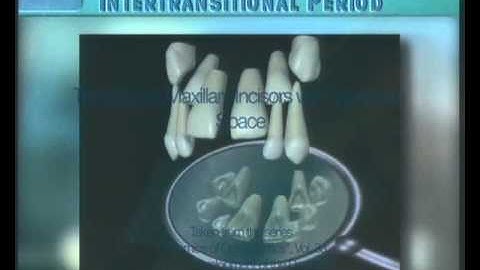 Clip 9: Transition of Maxillary Incisors with Moderate Space