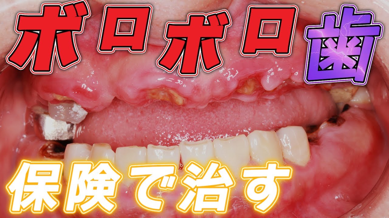 ボロボロ の 歯 治療