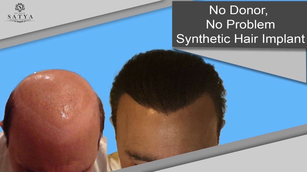 Synthetic Hair Transplant  Artificial Hair implant  Best Hair Transplant  Results  Nido Biofibre  YouTube