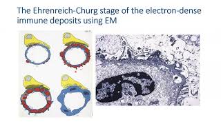 Membranous Nephropathy (2026) By Dr. Hameed Tareen