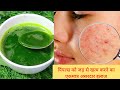 पुराने से पुराने पिंपल्स,दाग-धब्बे व किसी भी तरीके के निशान हटाएं Remove Pimples Easily/ Acne