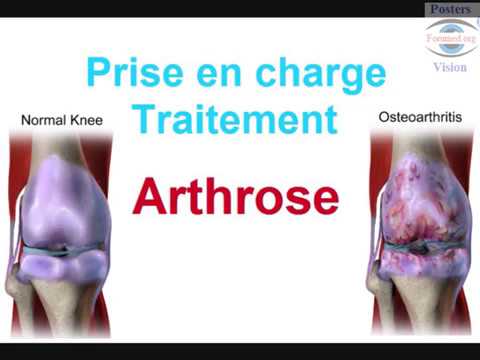 Traitement de l'Arthrose: douleur cervicale du genou..