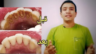 طريقه اخراج جميع التكلسات و الجير و البلاك المتراكم داخل اللثه و منع تكونه مره اخري