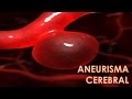 ANEURISMA CEREBRAL : MEDICINA HUMANA