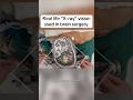 AI and AR combined #Medical #Medtok #Surgery #Surgeon #AR #AI