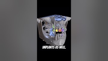 Completely Automatic CT Segmentation!  #blueskyplan #dentalsoftware #ct   #digitaldentistry