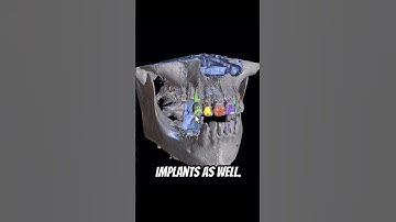 Completely Automatic CT Segmentation!  #blueskyplan #dentalsoftware #ct   #digitaldentistry