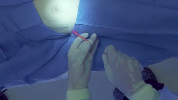 How to place a Cook Wayne Pigtail catheter