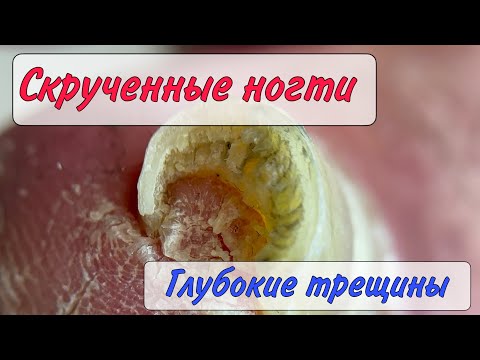 Скрученные ногти / кровавые трещины / трещины на ногах / как убрать трещины / болит палец