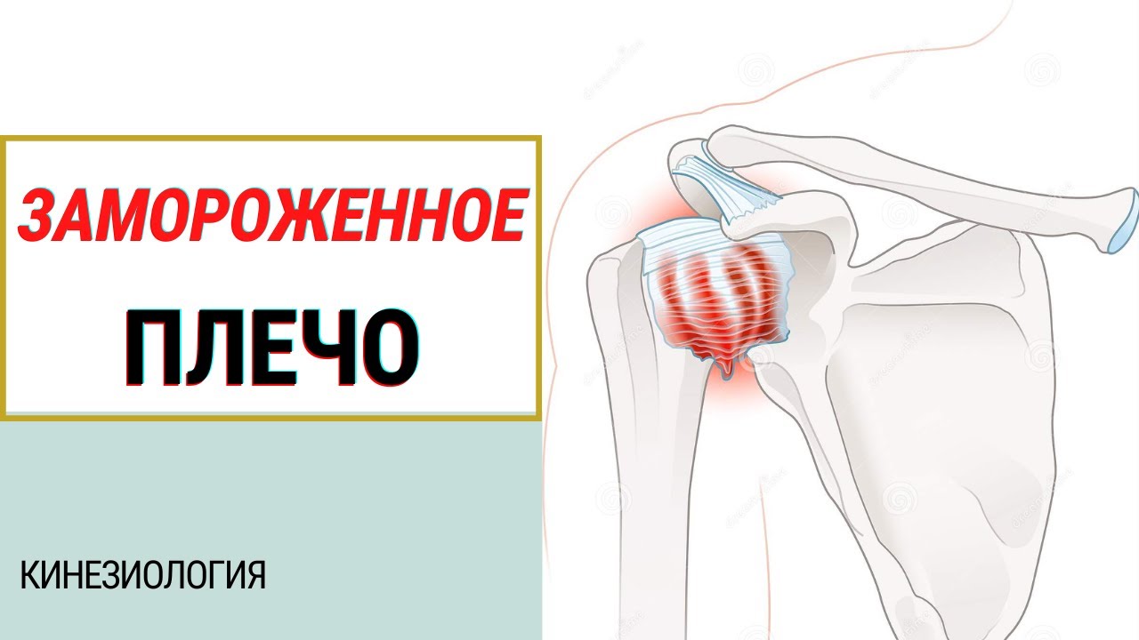 ЧТО БОЛИТ В ПЛЕЧЕ? ИМПИДЖМЕНТ-СИНДРОМ ПЛЕЧЕВОГО СУСТАВА. ПРИКЛАДНАЯ ...