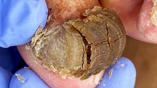 Massive Toenail Transformation: Over 10 Years of Growth!【Dr. Liu's Pedicur】