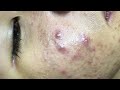 Suri Job 101: AWESOME INFLAMED BLACKHEADS FIELD | PART 1