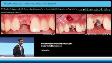 Implant Placement in the Esthetic Zone – Single Tooth Replacement  | Yucheng Su