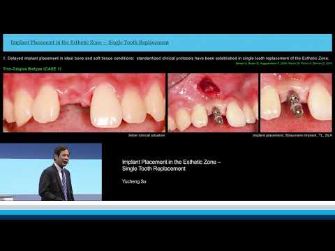 Implant Placement in the Esthetic Zone – Single Tooth Replacement | Yucheng Su