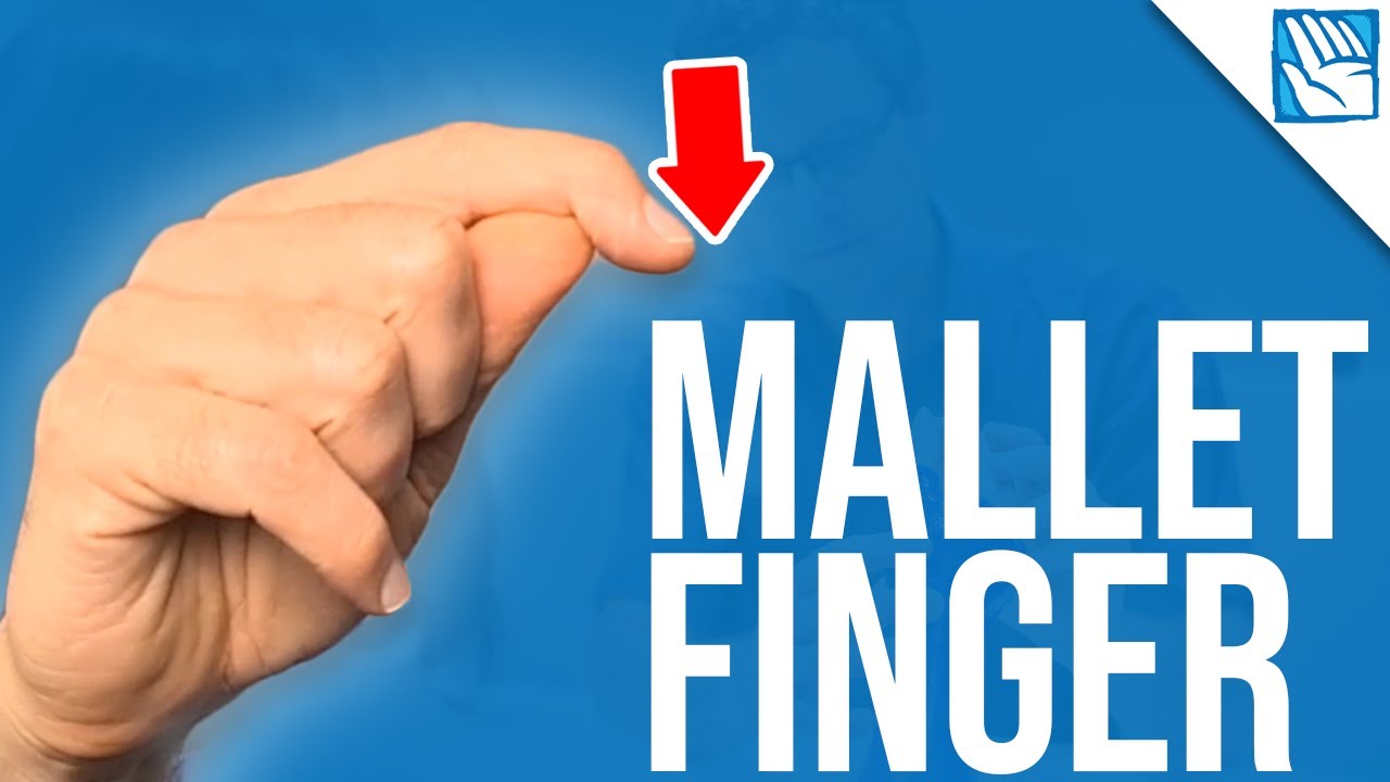 Can't Lift Your Fingertip ? - Mallet Finger  - Part 1