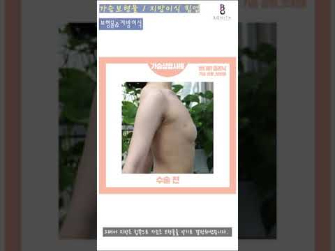 #shorts 보형물 가슴성형 전, 후 리얼후기