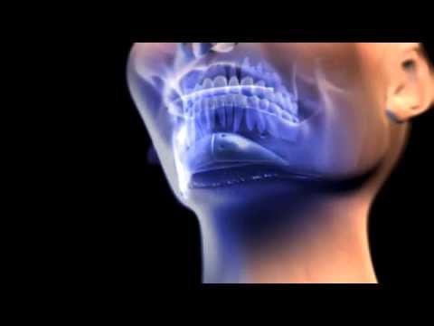 عملية تجميل الدقن بالسيليكون في تركيا كيف تتم عملية تجميل الدقن في تركيا 00905385844484