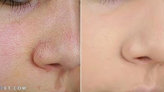 أسرع وصف للتضيق المسام الواسعه في الوجه The fastest description of narrowing large pores in the face