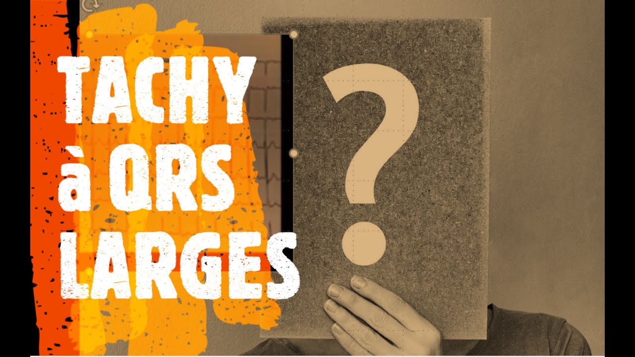 QUIZ ECG : TACHYCARDIE VENTRICULAIRE ou pas ?