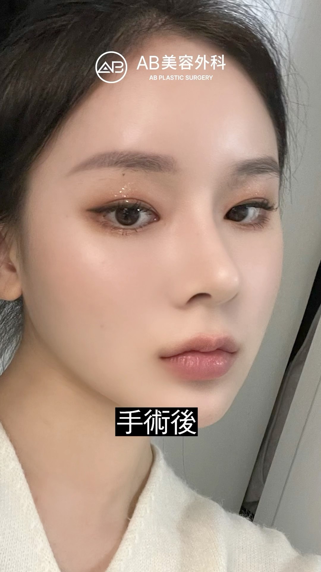 鼻整形でここまで変わる？衝撃のビフォーアフター！ | AB美容整形