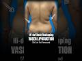 The Back Transformation You're Looking For #liposuction #beforeandafter