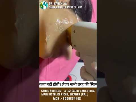 अनच ह ब ल हम श क ल ए हट ए ल जर 