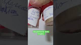 Sinusectomia-bola fungica.