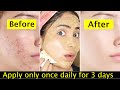 Teenager Skin Transformation Challenge-Pimples, whiteheads, acne marks clearing &amp; face brightening
