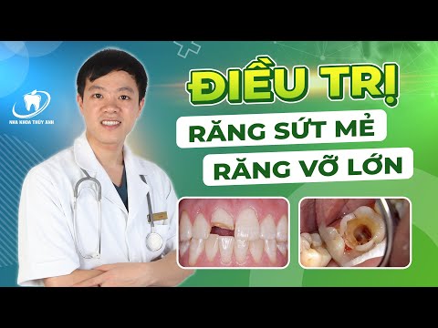 Video: Cách Bảo vệ Răng Sứt mẻ (Có Hình ảnh)