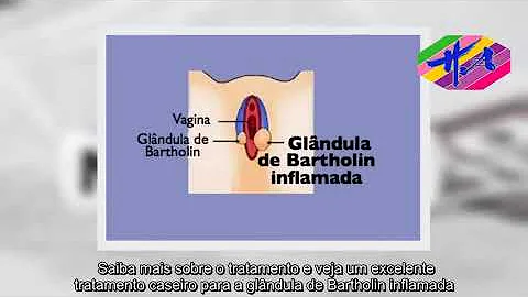 Como é feita a cirurgia para retirada da glândula de Bartholin?