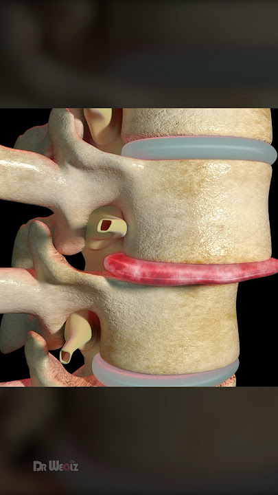 Intervertebral Disc Replacement: 3D Animation