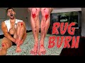 Creating the worst rug burn injury of all time scarred for life