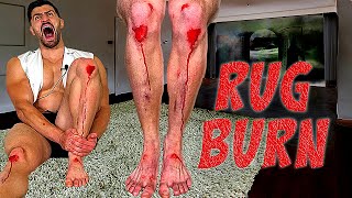 Creating the WORST RUG BURN INJURY of all Time *SCARRED FOR LIFE*