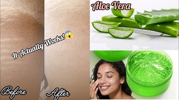Using Aloe Vera Gel On My Stretch Marks Actually Did For Me - You Won