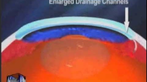 Canaloplasty - new glaucoma surgery  | Fox New Marcos