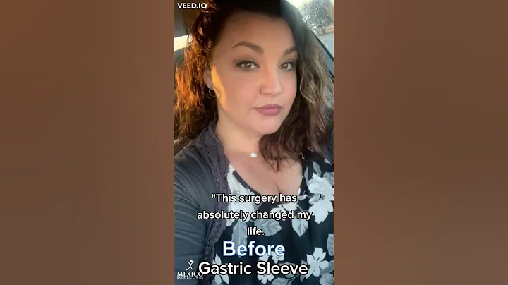 Getting a gastric sleeve was the best decision I made!