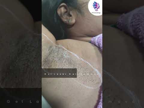 Get Rid of under-arm hair by Laser Hair Removal Treatment | VJ’s Cosmetology Clinic